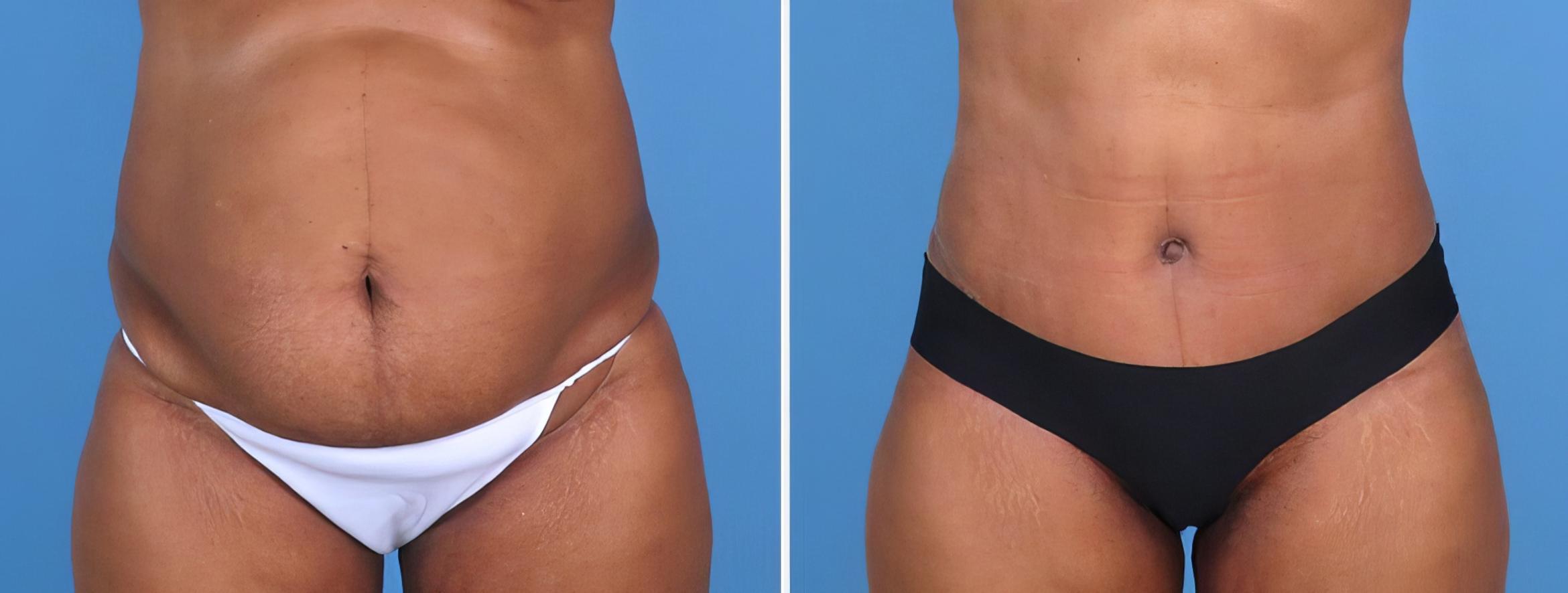 Before & After Tummy Tuck Case 27022 View #1 View in Alpharetta, GA