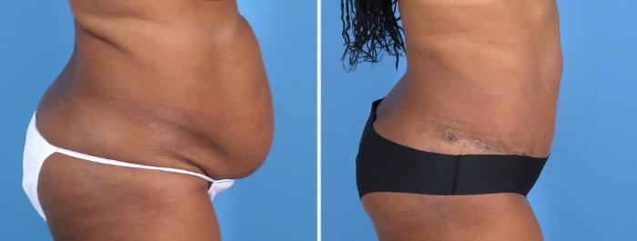 Before & After Tummy Tuck Case 27022 View #2 View in Alpharetta, GA