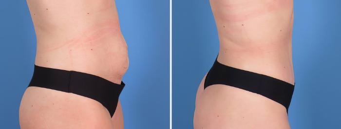 Before & After Tummy Tuck Case 27155 View #2 View in Alpharetta, GA