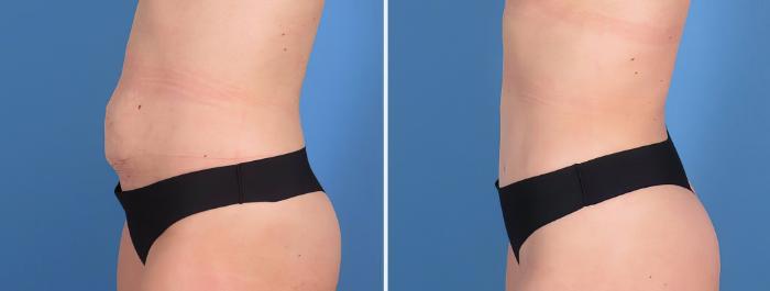 Before & After Tummy Tuck Case 27155 View #3 View in Alpharetta, GA
