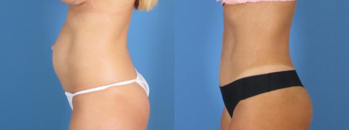 Before & After Tummy Tuck Case 28308 Left Side View in Alpharetta, GA