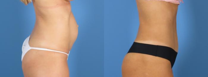 Before & After Tummy Tuck Case 28308 Right Side View in Alpharetta, GA