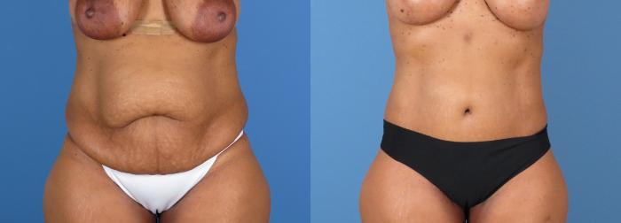 Before & After Tummy Tuck Case 28310 Front View in Alpharetta, GA