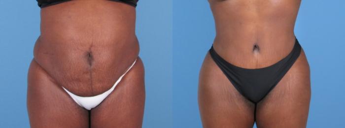 Before & After Tummy Tuck Case 28311 Front View in Alpharetta, GA