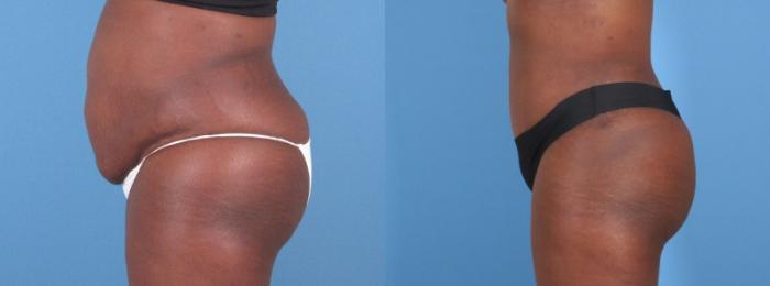 Before & After Tummy Tuck Case 28311 Left Side View in Alpharetta, GA