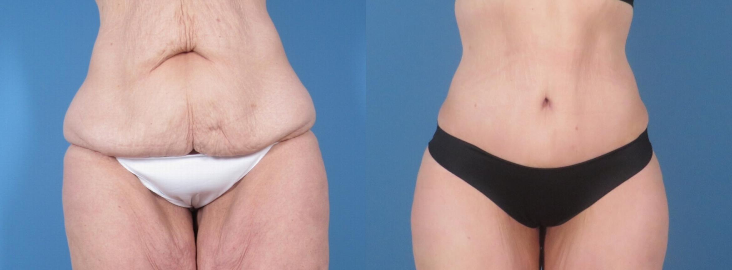 Before & After Tummy Tuck Case 28312 Front View in Alpharetta, GA