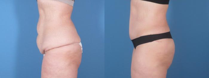 Before & After Tummy Tuck Case 28312 Left Side View in Alpharetta, GA