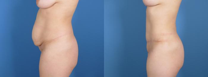 Before & After Tummy Tuck Case 28315 Left Side View in Atlanta, GA